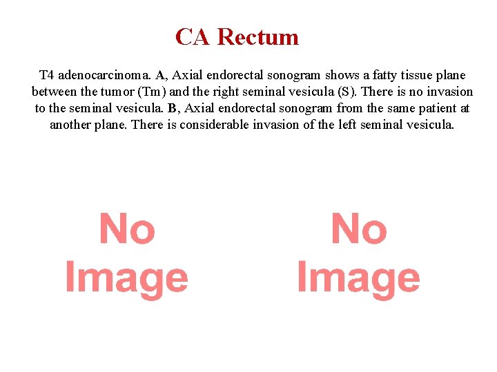 CA Rectum T 4 adenocarcinoma. A, Axial endorectal sonogram shows a fatty tissue plane