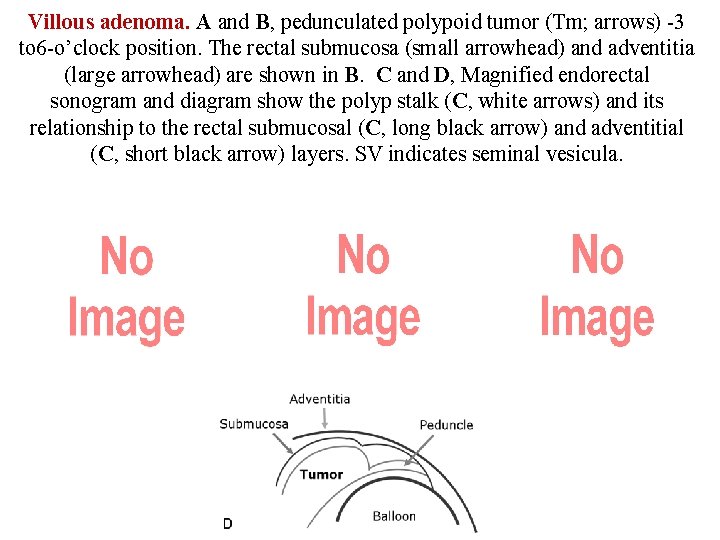 Villous adenoma. A and B, pedunculated polypoid tumor (Tm; arrows) -3 to 6 -o’clock