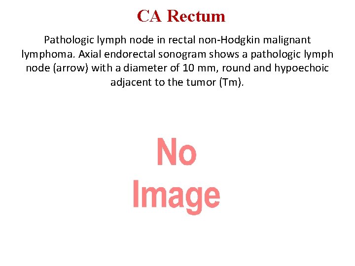 CA Rectum Pathologic lymph node in rectal non-Hodgkin malignant lymphoma. Axial endorectal sonogram shows