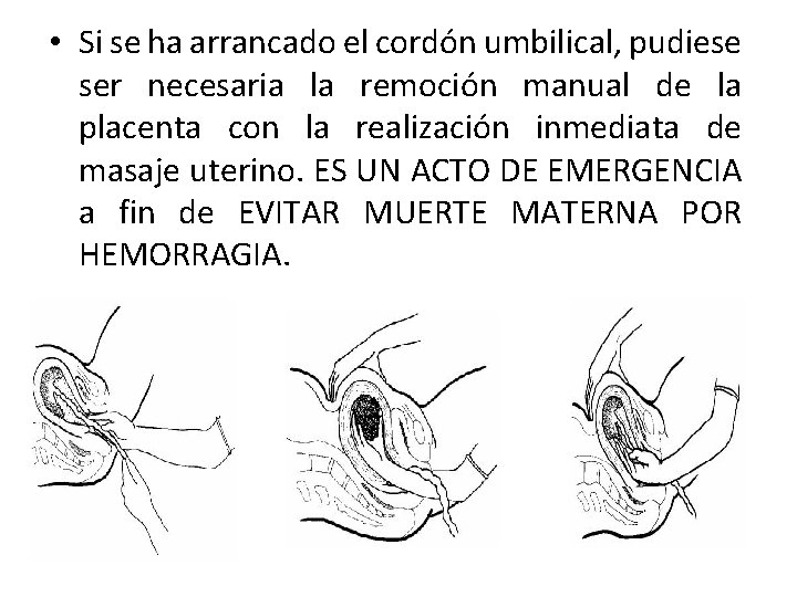 • Si se ha arrancado el cordón umbilical, pudiese ser necesaria la remoción • Si se ha arrancado el cordón umbilical, pudiese ser necesaria la remoción