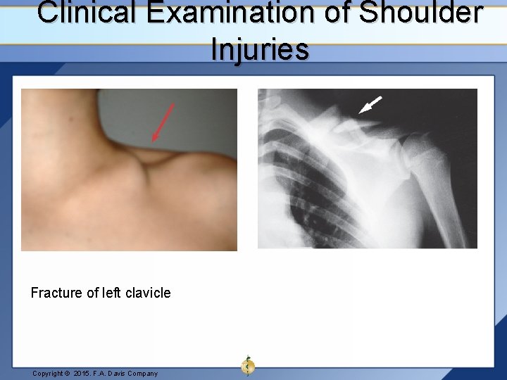 Clinical Examination of Shoulder Injuries Fracture of left clavicle Copyright © 2015. F. A.