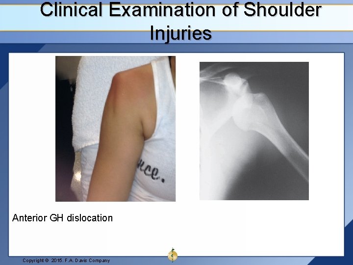 Clinical Examination of Shoulder Injuries Anterior GH dislocation Copyright © 2015. F. A. Davis
