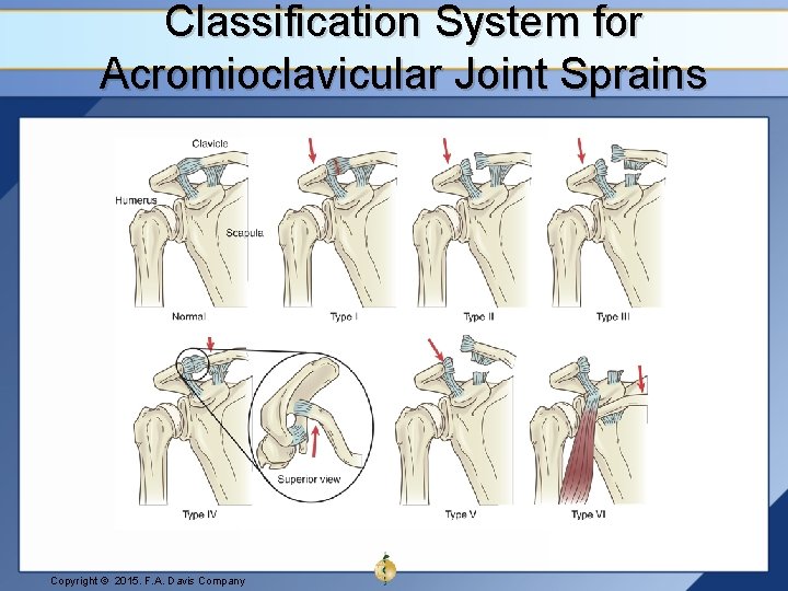 Classification System for Acromioclavicular Joint Sprains Copyright © 2015. F. A. Davis Company 