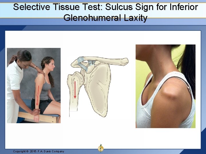 Selective Tissue Test: Sulcus Sign for Inferior Glenohumeral Laxity Copyright © 2015. F. A.