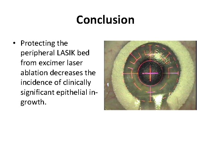 Conclusion • Protecting the peripheral LASIK bed from excimer laser ablation decreases the incidence