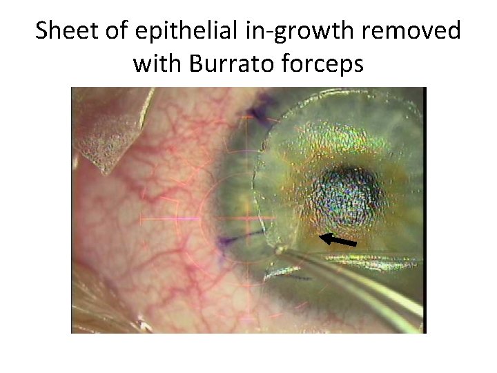 Sheet of epithelial in-growth removed with Burrato forceps 