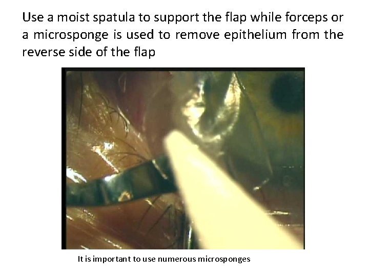 Use a moist spatula to support the flap while forceps or a microsponge is