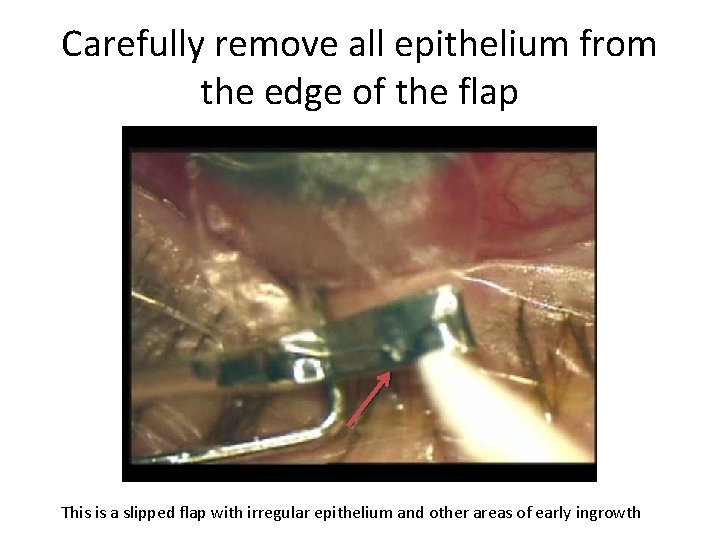 Carefully remove all epithelium from the edge of the flap This is a slipped