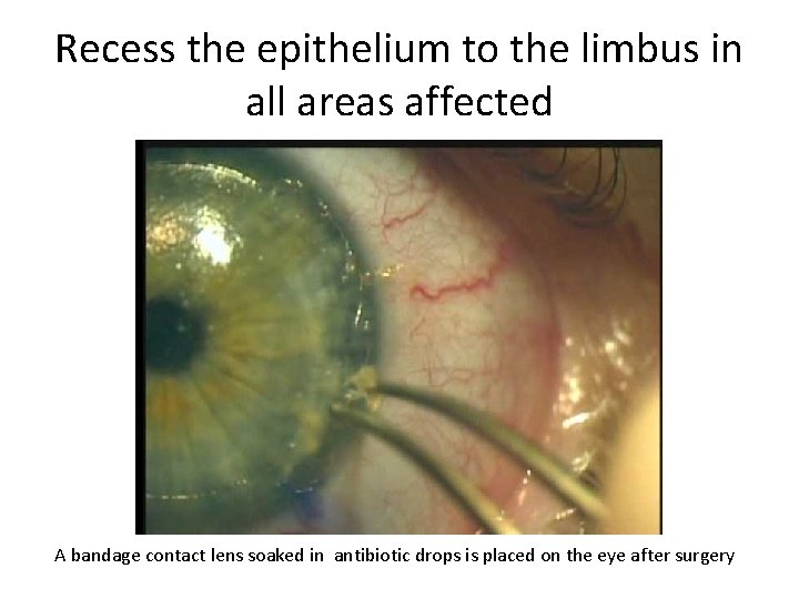 Recess the epithelium to the limbus in all areas affected A bandage contact lens