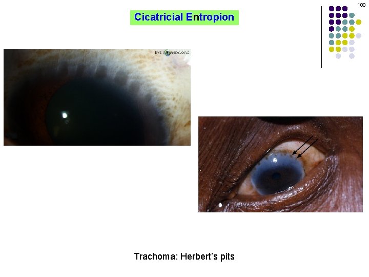 100 Cicatricial Entropion Trachoma: Herbert’s pits 