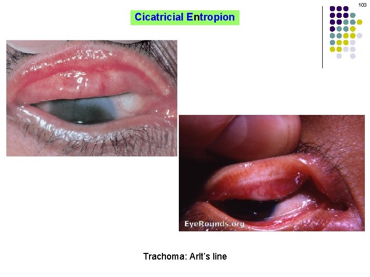 103 Cicatricial Entropion Trachoma: Arlt’s line 