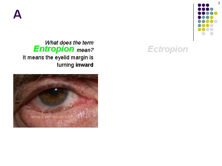 2 A What does the term Entropion mean? It means the eyelid margin is