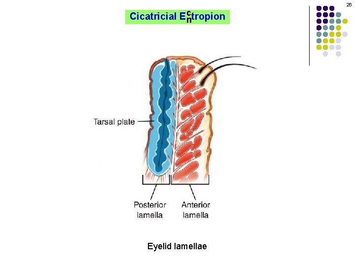 26 c Cicatricial Ectropion n Eyelid lamellae 