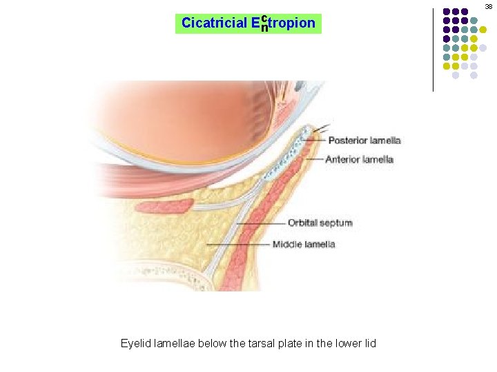 38 c Cicatricial Ectropion n Eyelid lamellae below the tarsal plate in the lower