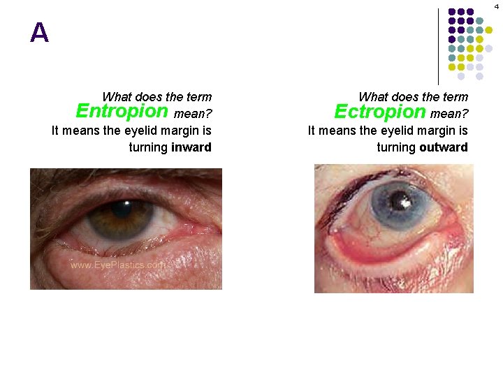 4 A What does the term Entropion mean? It means the eyelid margin is