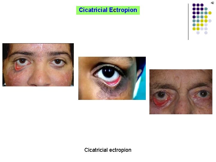 42 Cicatricial Ectropion Cicatricial ectropion 