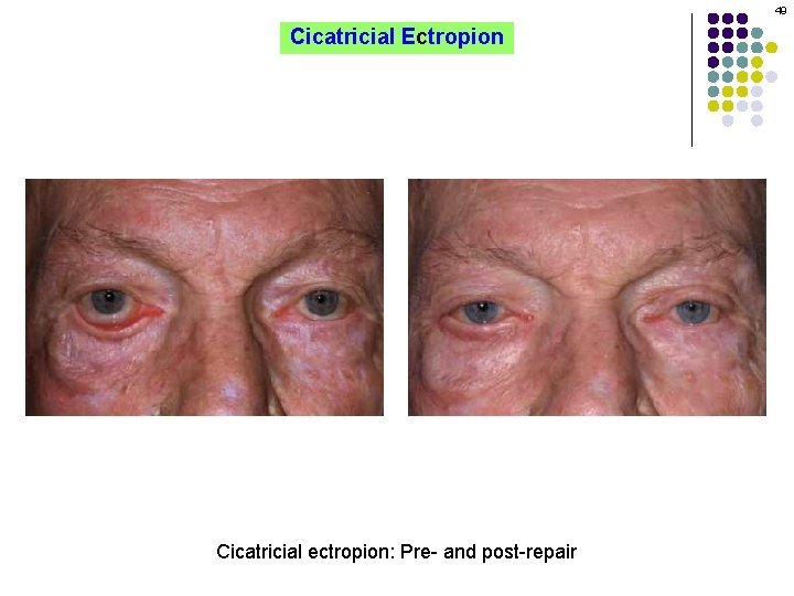 49 Cicatricial Ectropion Cicatricial ectropion: Pre- and post-repair 