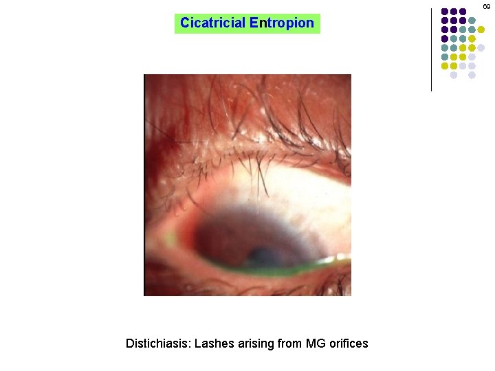 69 Cicatricial Entropion Distichiasis: Lashes arising from MG orifices 