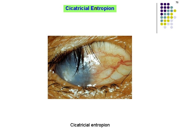 78 Cicatricial Entropion Cicatricial entropion 