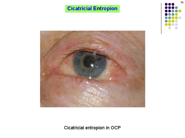 79 Cicatricial Entropion Cicatricial entropion in OCP 