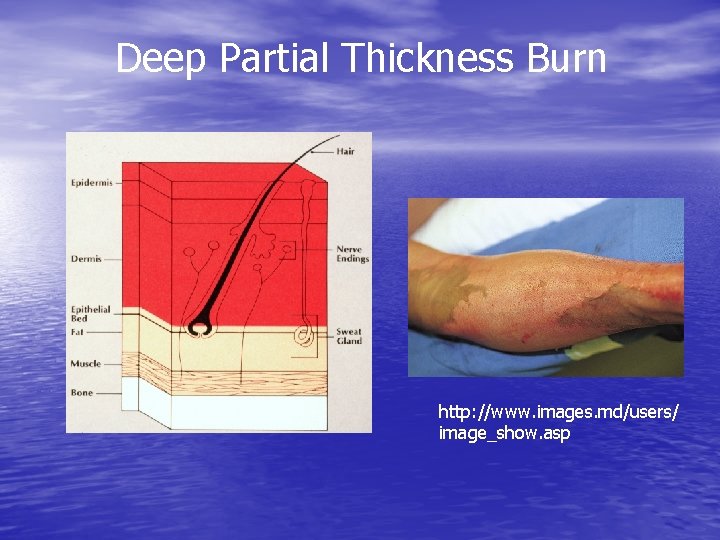 Deep Partial Thickness Burn http: //www. images. md/users/ image_show. asp 
