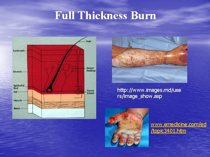 Full Thickness Burn http: //www. images. md/use rs/image_show. asp www. emedicine. com/ed /topic 3401.