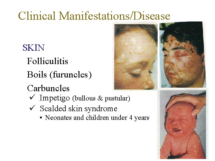 Clinical Manifestations/Disease SKIN Folliculitis Boils (furuncles) Carbuncles Impetigo (bullous & pustular) Scalded skin syndrome