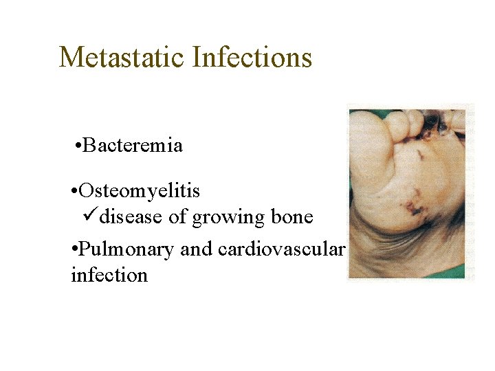 Metastatic Infections • Bacteremia • Osteomyelitis disease of growing bone • Pulmonary and cardiovascular