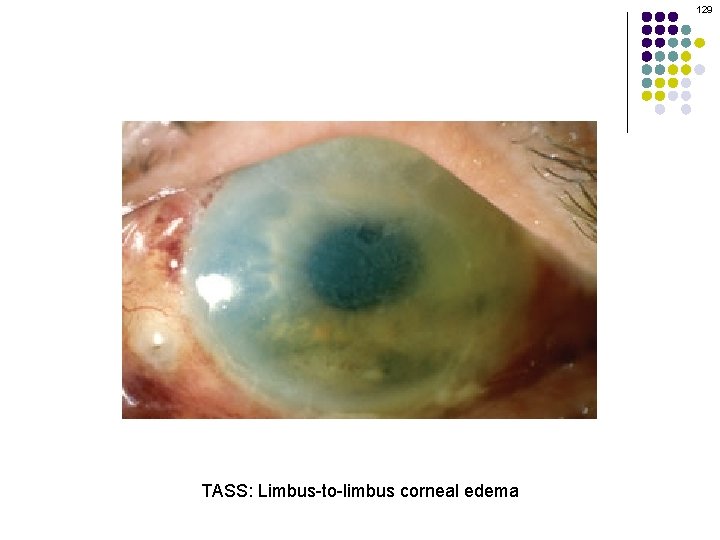 129 TASS: Limbus-to-limbus corneal edema 