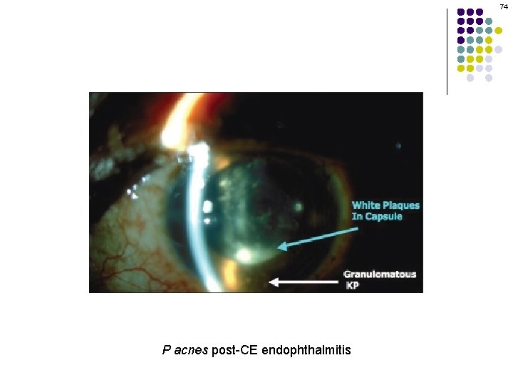 74 P acnes post-CE endophthalmitis 