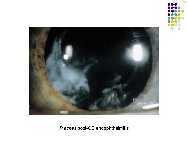 75 P acnes post-CE endophthalmitis 