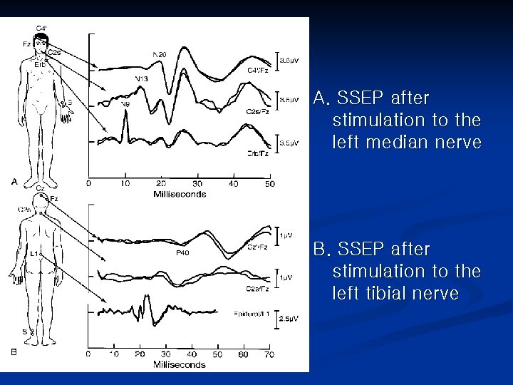 A. SSEP after stimulation to the left median nerve B. SSEP after stimulation to