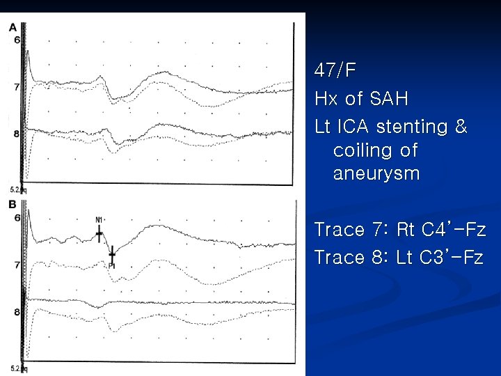 47/F Hx of SAH Lt ICA stenting & coiling of aneurysm Trace 7: Rt