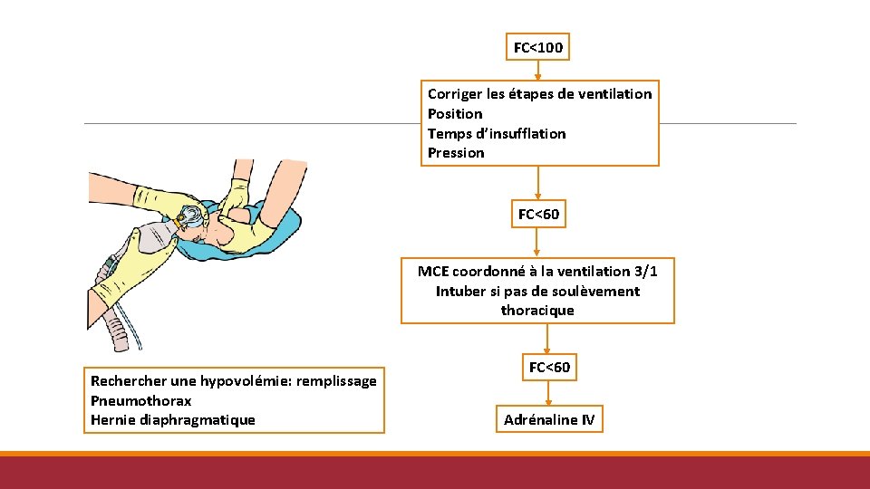 FC<100 Corriger les étapes de ventilation Position Temps d’insufflation Pression FC<60 MCE coordonné à FC<100 Corriger les étapes de ventilation Position Temps d’insufflation Pression FC<60 MCE coordonné à
