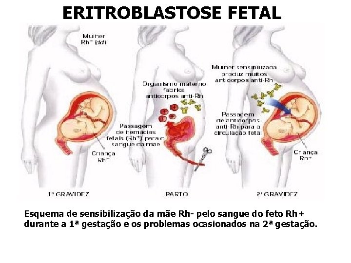 ERITROBLASTOSE FETAL Esquema de sensibilização da mãe Rh- pelo sangue do feto Rh+ durante ERITROBLASTOSE FETAL Esquema de sensibilização da mãe Rh- pelo sangue do feto Rh+ durante