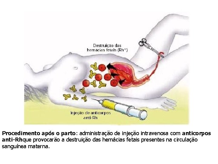 Procedimento após o parto: administração de injeção intravenosa com anticorpos anti-Rhque provocarão a destruição Procedimento após o parto: administração de injeção intravenosa com anticorpos anti-Rhque provocarão a destruição