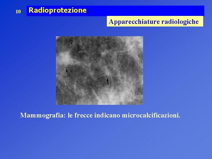 10 Radioprotezione Apparecchiature radiologiche Mammografia: le frecce indicano microcalcificazioni. 