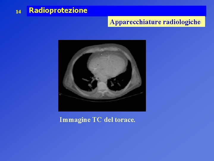 14 Radioprotezione Apparecchiature radiologiche Immagine TC del torace. 