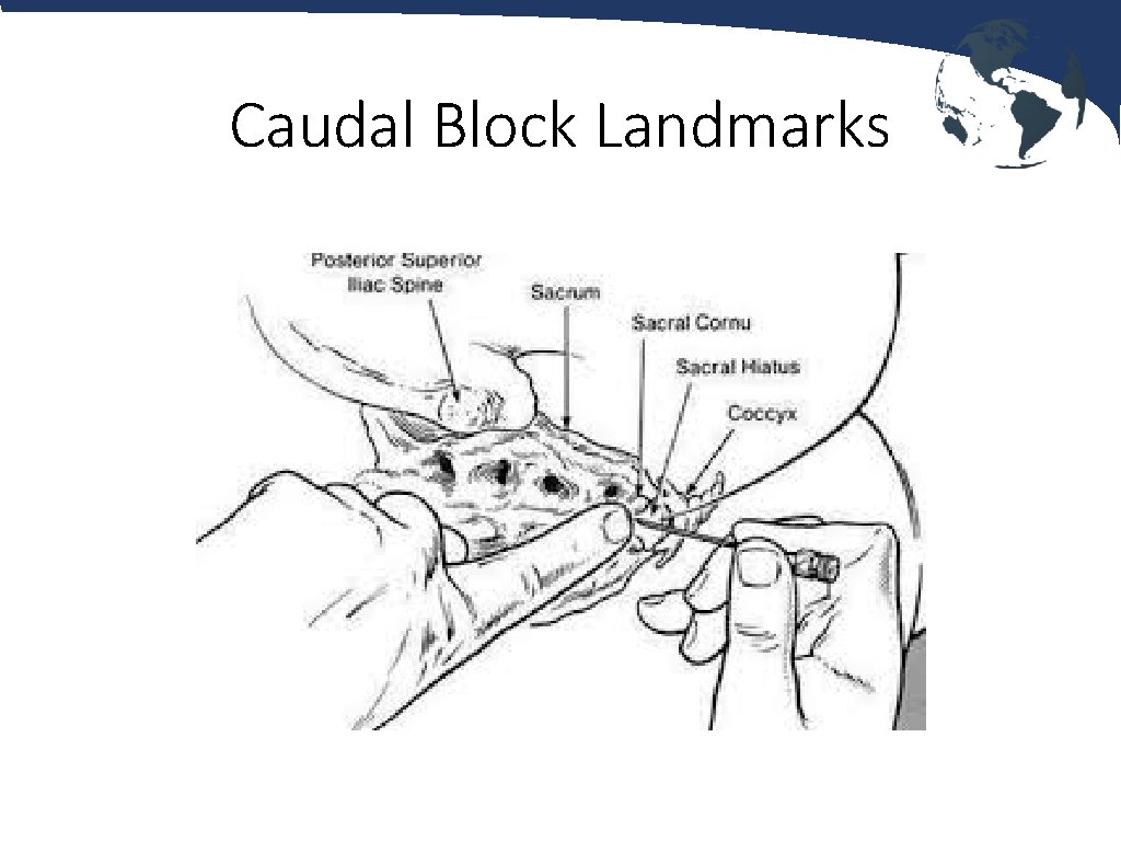 Caudal Block Landmarks 