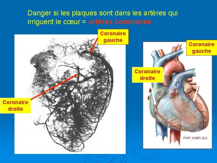 Danger si les plaques sont dans les artères qui irriguent le cœur = artères