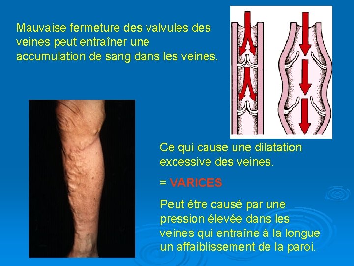 Mauvaise fermeture des valvules des veines peut entraîner une accumulation de sang dans les