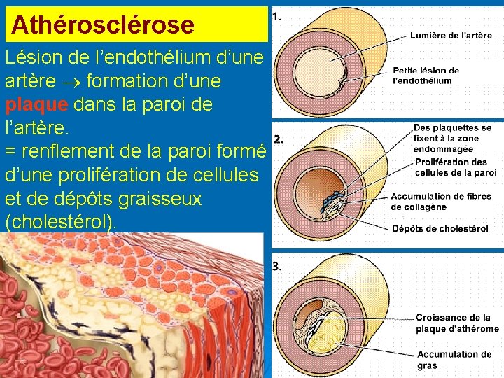 Athérosclérose Lésion de l’endothélium d’une artère formation d’une plaque dans la paroi de l’artère.