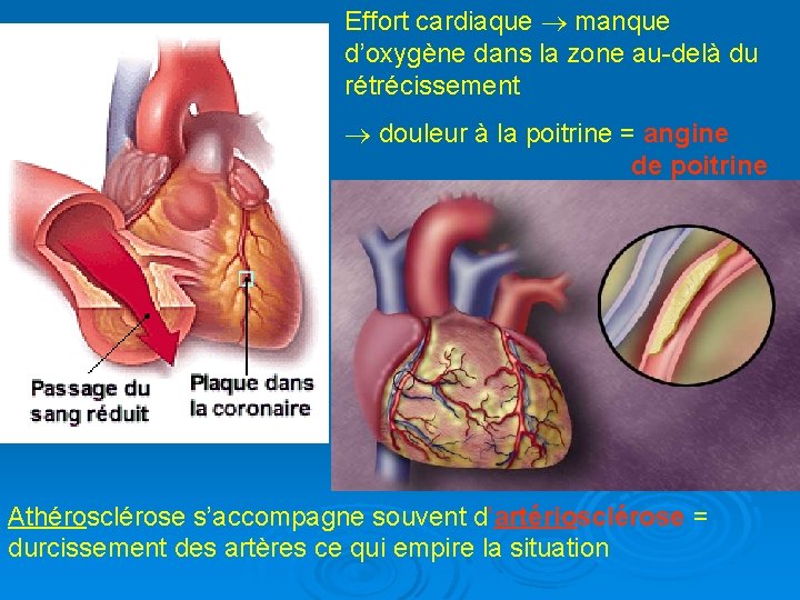 Effort cardiaque manque d’oxygène dans la zone au-delà du rétrécissement douleur à la poitrine
