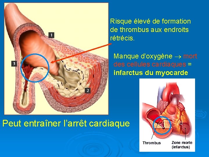 Risque élevé de formation de thrombus aux endroits rétrécis. Manque d’oxygène mort des cellules