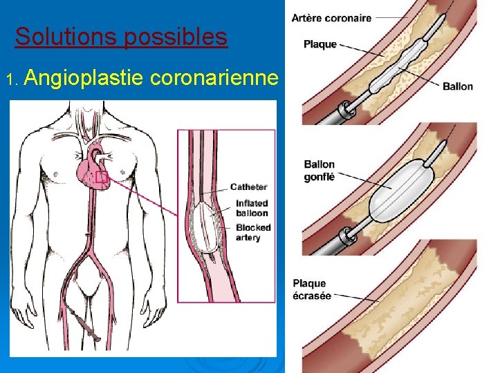 Solutions possibles 1. Angioplastie coronarienne 