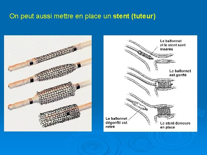 On peut aussi mettre en place un stent (tuteur) 
