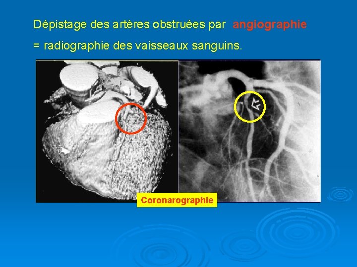 Dépistage des artères obstruées par angiographie = radiographie des vaisseaux sanguins. Coronarographie 