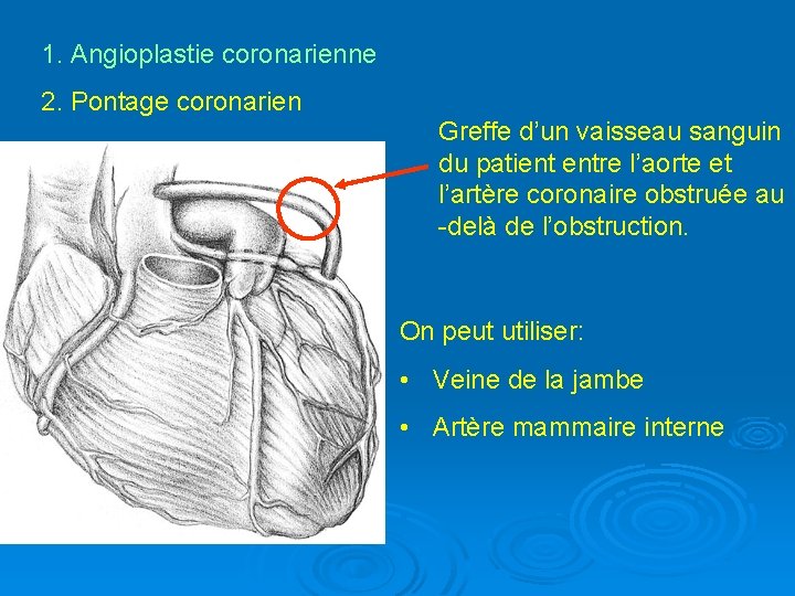 1. Angioplastie coronarienne 2. Pontage coronarien Greffe d’un vaisseau sanguin du patient entre l’aorte