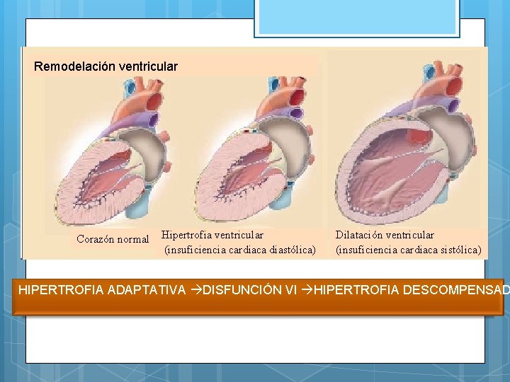 Remodelación ventricular Corazón normal Hipertrofia ventricular (insuficiencia cardiaca diastólica) Dilatación ventricular (insuficiencia cardiaca sistólica)