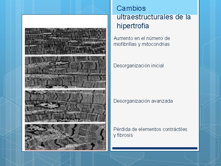 Cambios ultraestructurales de la hipertrofia Aumento en el número de miofibrillas y mitocondrias Desorganización